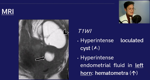 Herlyn-Werner-Wunderlich syndrome with Endometriotic cyst